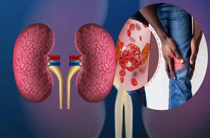जिम जा रहे हैं तो सावधान! ज्यादा प्रोटीन से बन रही है बॉडी, लेकिन धीरे-धीरे खराब हो रही किडनी जानिए कैसे ?