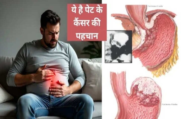 पेट में कैंसर की शुरुआत में नजर आते हैं ये 5 लक्षण, अनदेखा किया तो जान पर आ सकती है बात 